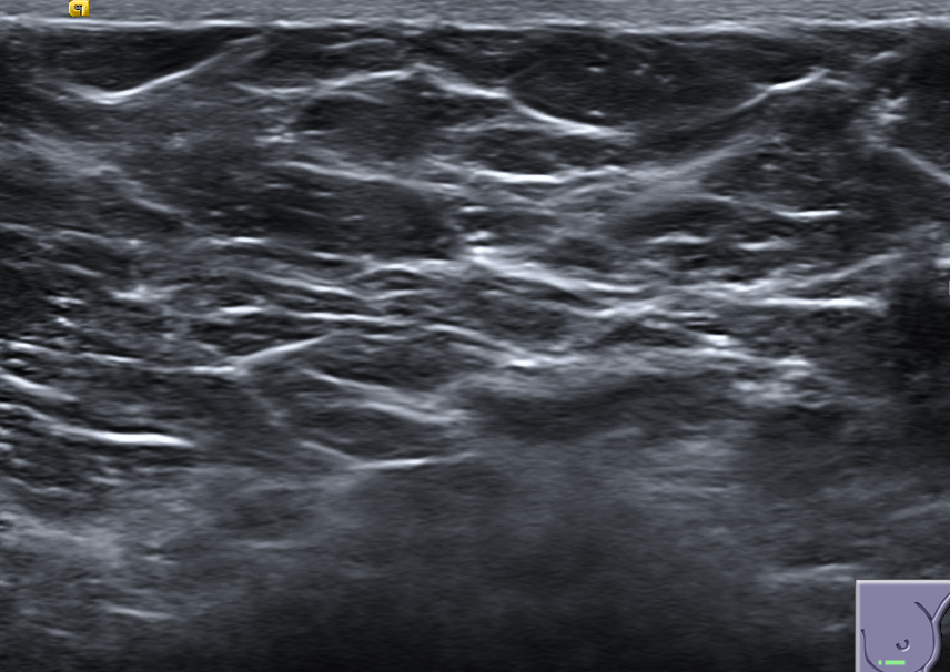 Breast ultrasound sample used in the demonstration